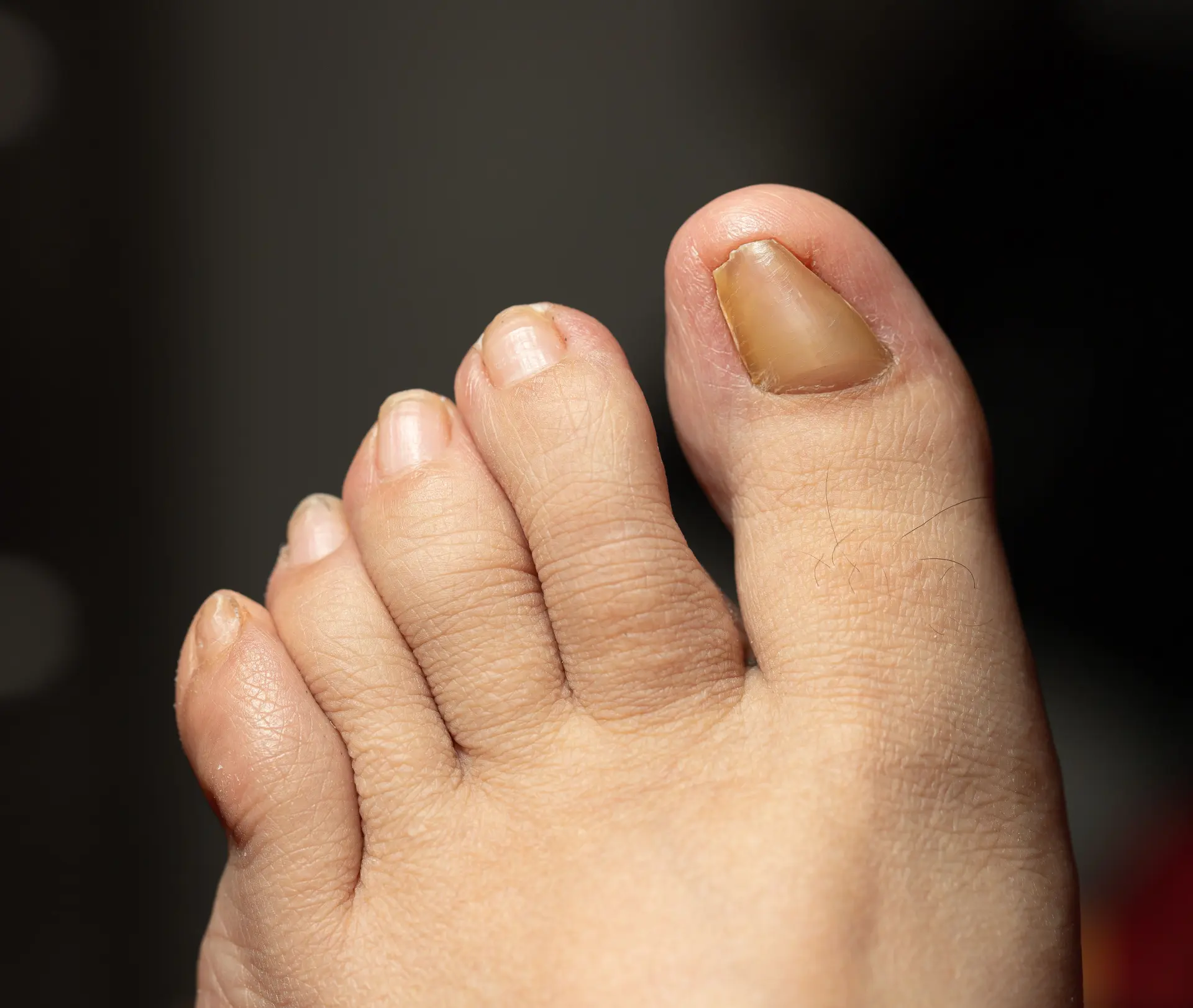Ingrowing Toenails