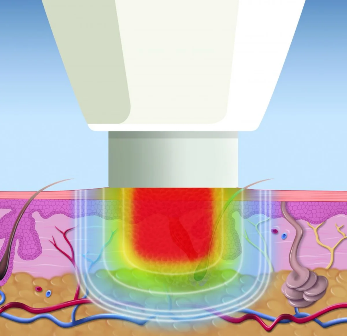 Illustration of a treatment applicator positioned over a verruca
