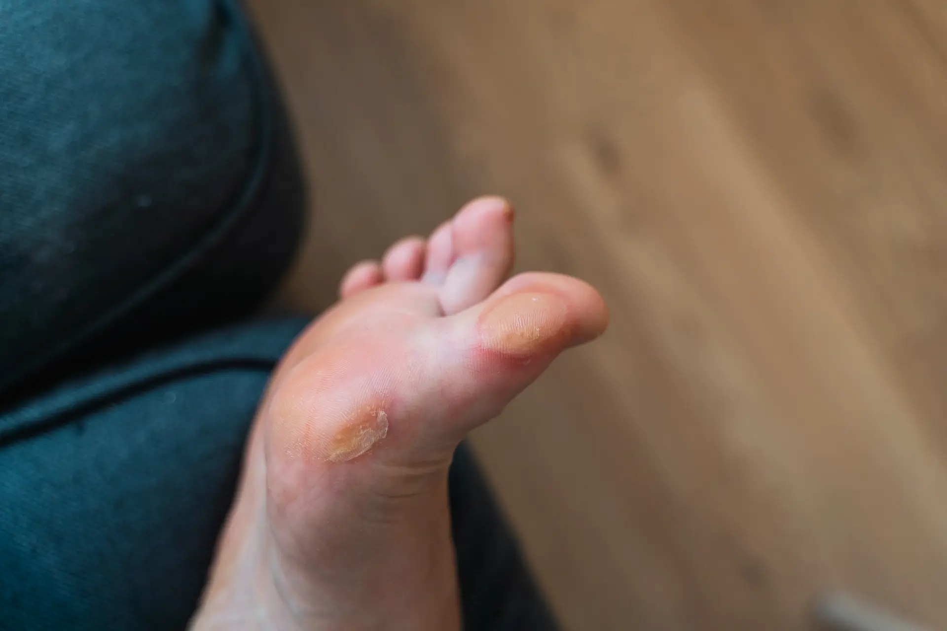 What Is A Corn and What Is A Callus?